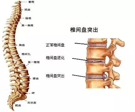 探索前沿：腰间盘突出治疗的最新突破与高效方案